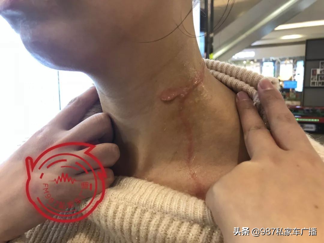 福州一女子进店美发，竟遭滚烫蒸汽喷射……疤痕吓人！