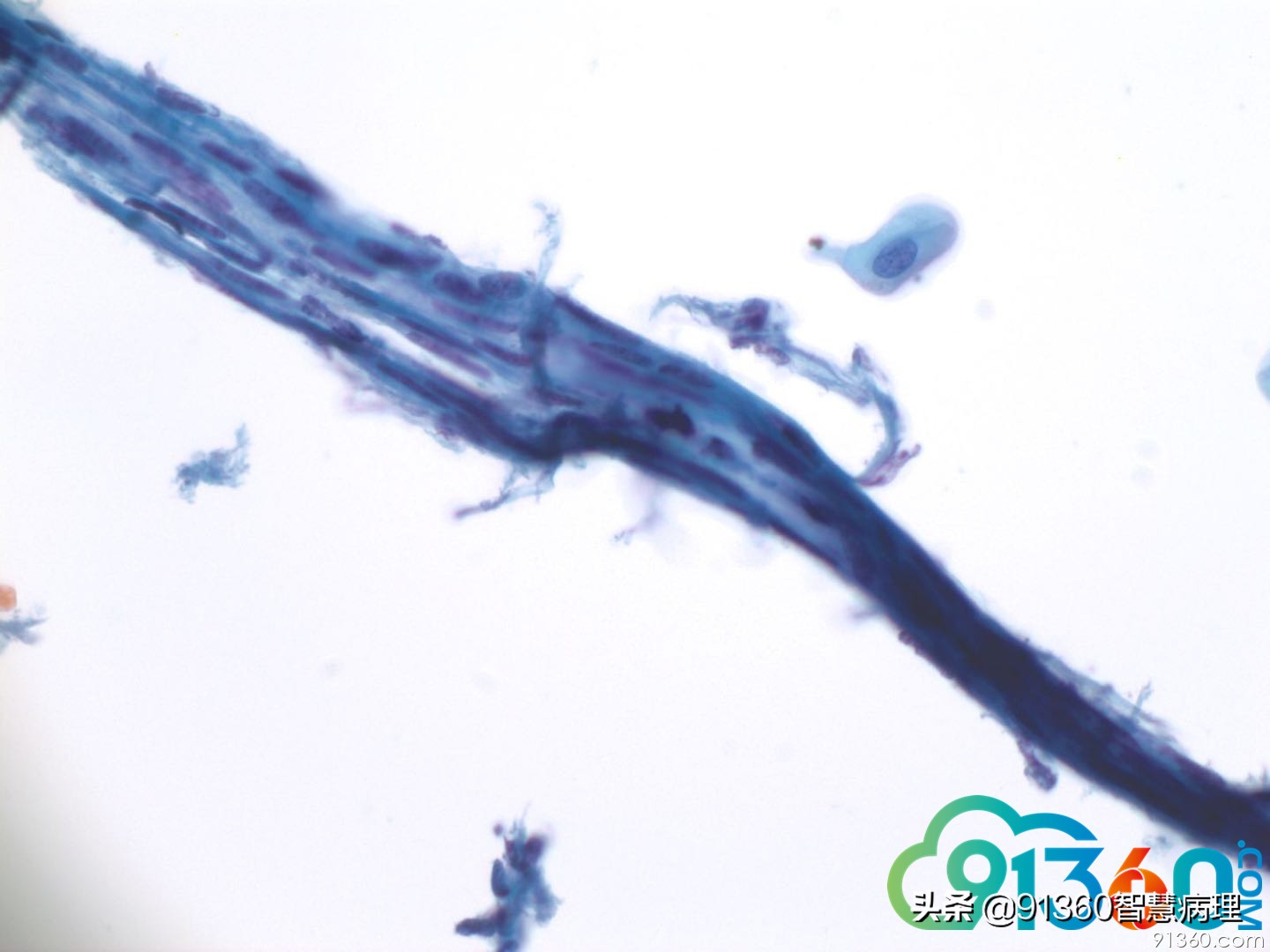 宫颈病理tct是什么检查,tct出现ascus会是宫颈癌吗
