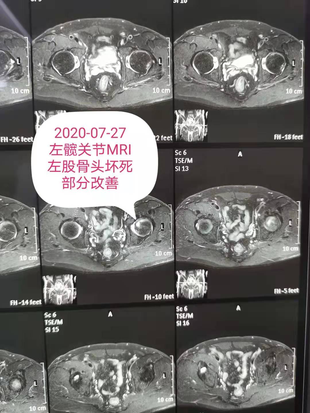 久久为功！水矿总医院以冲击波为主治疗一例股骨头坏死病例效果不错