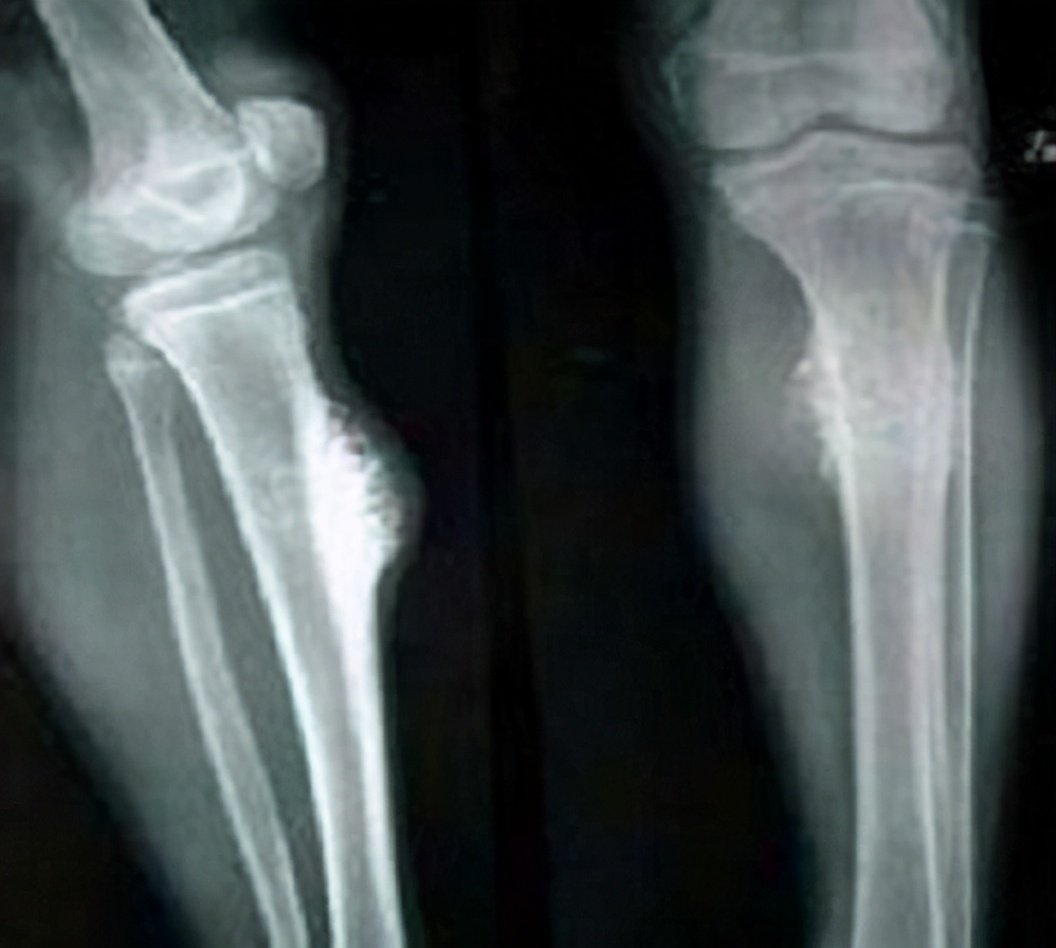 癌症骨转移要打骨头针吗,乳腺癌骨转移单纯是骨头疼吗