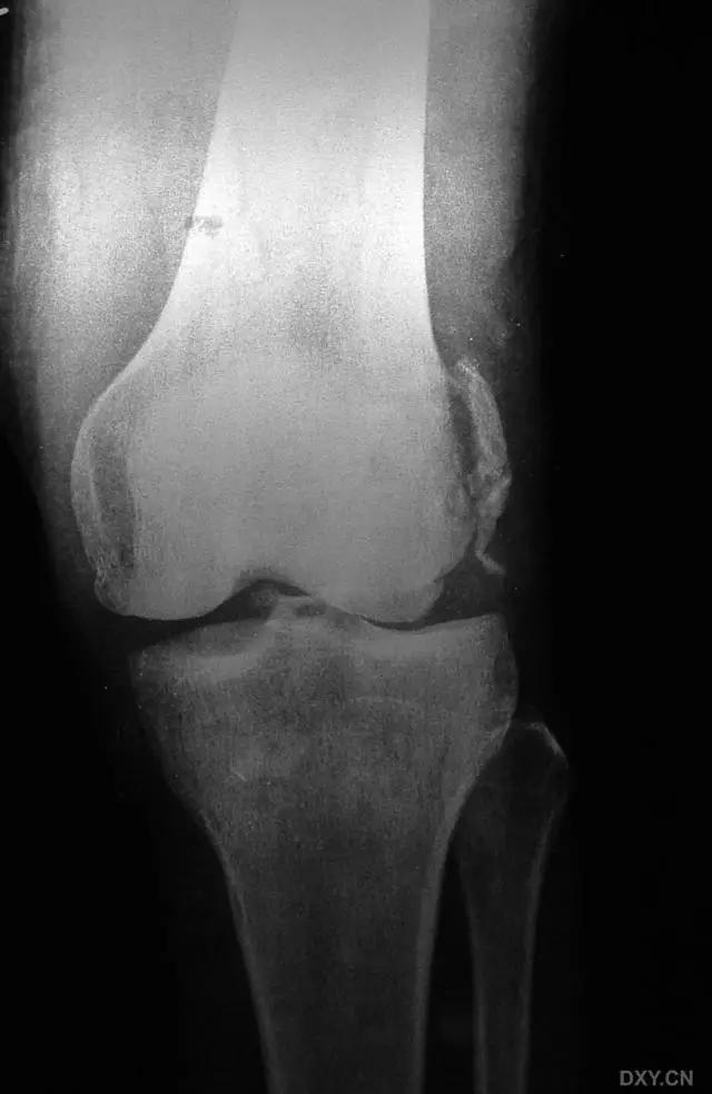 所有骨折都叫什么名字,骨折的名称有哪些