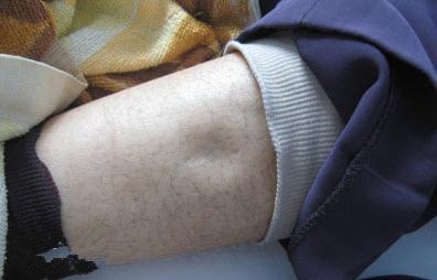 长期脚脖肿怎么回事,脚脖子肿疼用什么能好得快