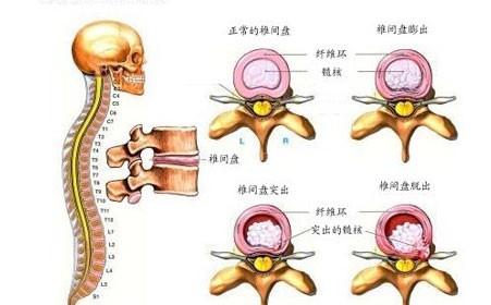腰突手术后腰部多久能恢复正常,腰突手术为什么会复发