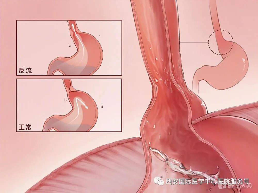 咳嗽不止很是难受,咳嗽不止容易犯呕
