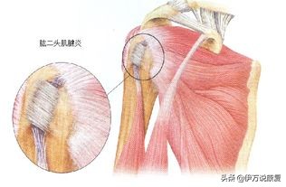 肩周炎：身“肩”重担，怎么治疗才能不带“炎”？