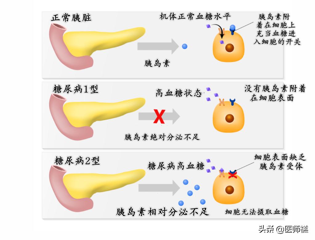 中医可以调理糖尿病降低餐后血糖,姜对降血糖的作用和功效
