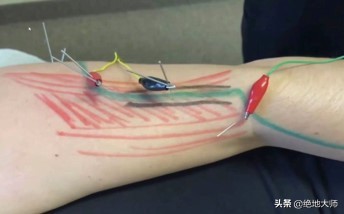 手神经外伤康复视频,治疗手神经损伤的药