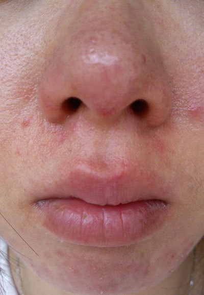 青少年女生满脸痘怎么治,花季少女如何不长痘痘