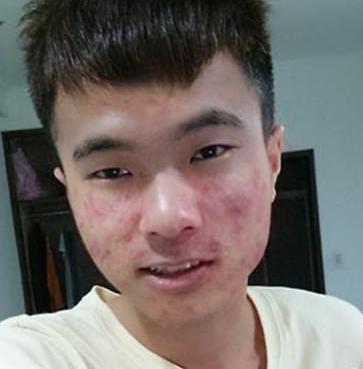 青春期男生开始爆痘，先力所能及的养成这11个习惯，痘痘会少很多