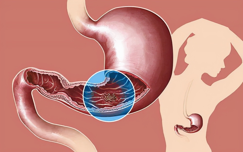 治疗消化性溃疡的中成药,西咪替丁治疗消化性溃疡的机制