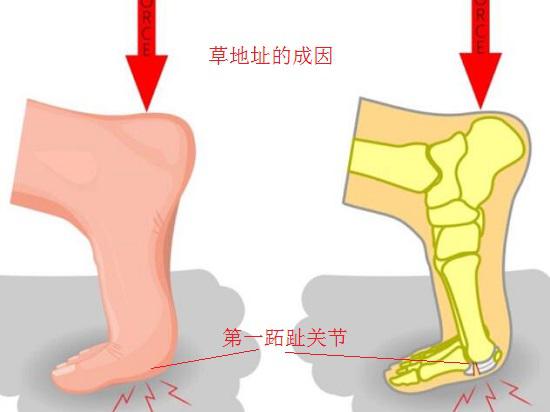 草皮趾什么症状,草地趾怎么康复