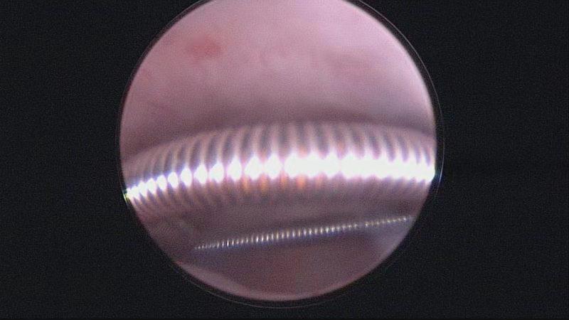 安徽宫腔镜手术专家排名,安徽省立宫腔镜哪个医生做的好