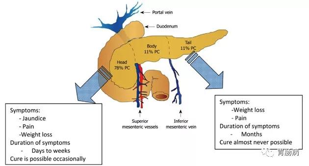 癌症之王胰腺癌晚期能活多久,癌症之王胰腺癌患者视频