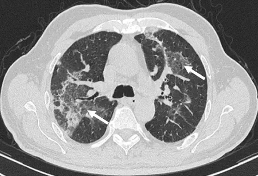 机化性肺炎平时应关注什么,机化性肺炎的正规治疗