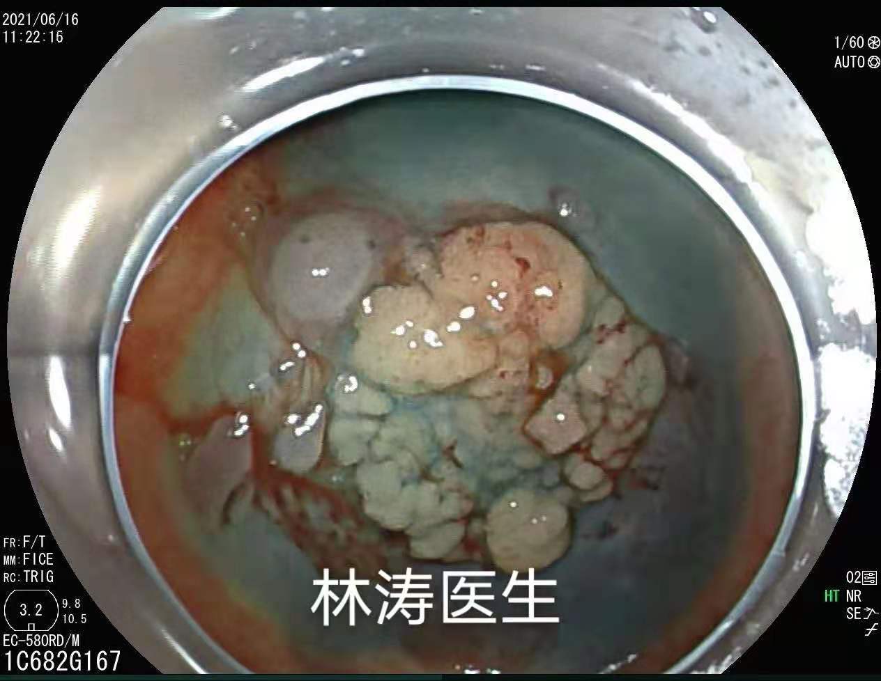 医学博士的忠告,医学博士曝光肿瘤过度治疗