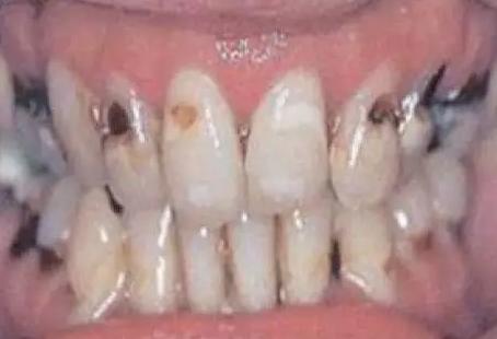 为什么吸毒的人掉牙齿,吸毒的人为什么会烂牙齿