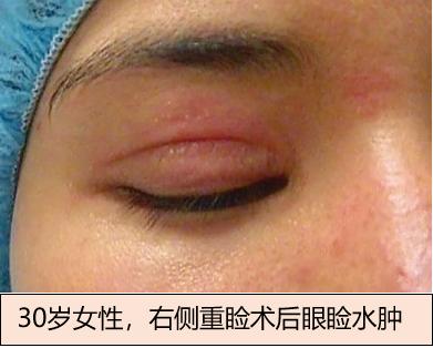 潜藏在医学美容背后的感染陷阱