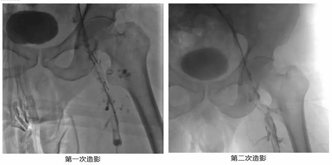 DVT合并PE不可怕，教科书式的护理来啦！