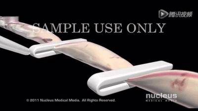 顺产怕侧切和撕裂怎么办,顺产侧切好过剖宫产吗