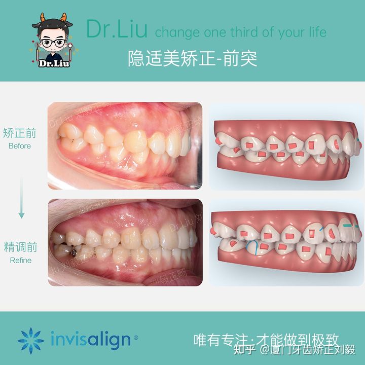 拔牙正畸矫正全过程3d,拔牙嘴凸正畸的真实案例