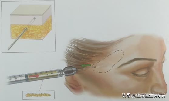 用自体脂肪填充有什么副作用,用自体脂肪填充太阳穴