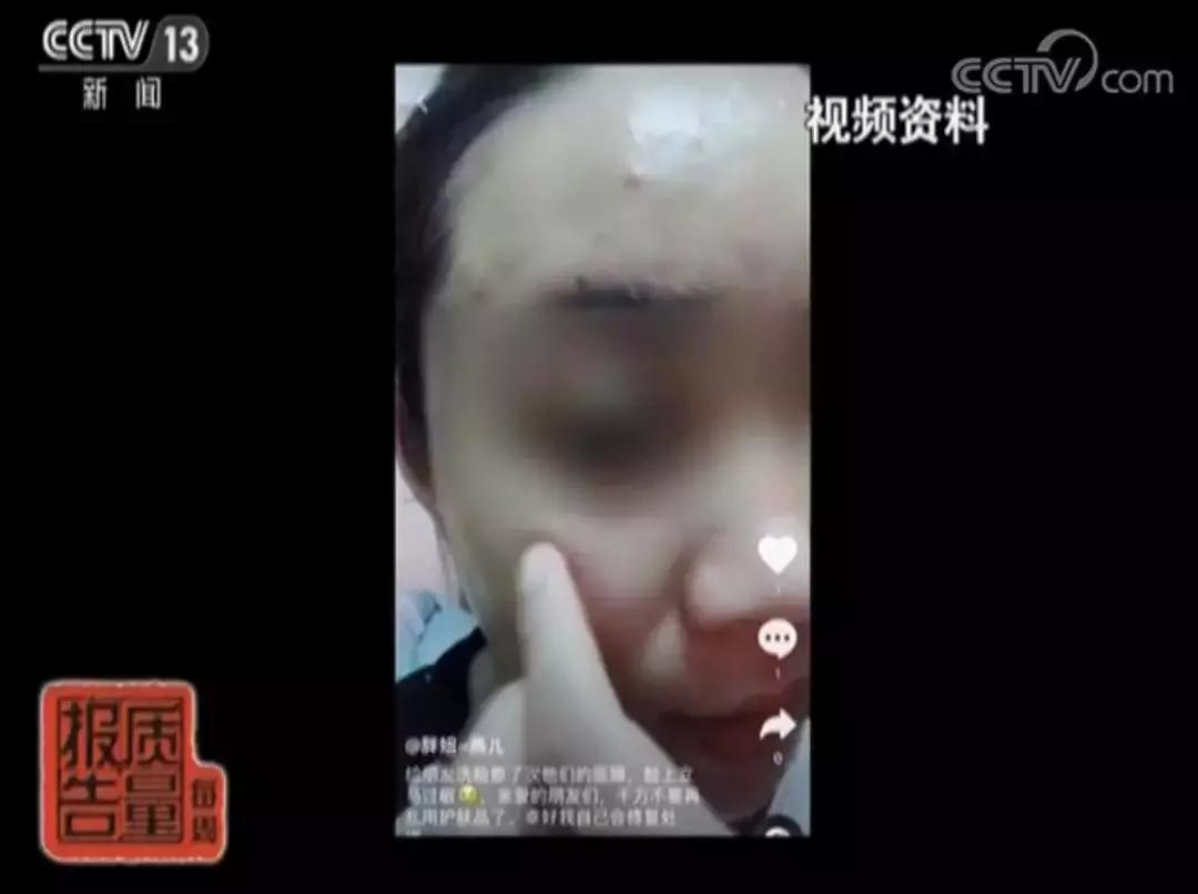 长期使用激素面膜的危害,面膜烂脸