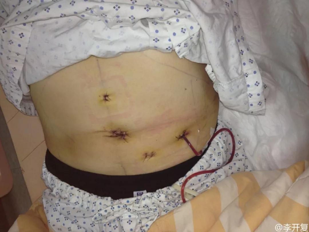 90后妈妈发现胃癌晚期,孕晚期确诊胃癌晚期