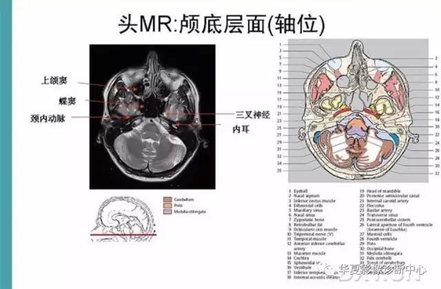mra头颅解剖学详细讲解视频,常见的头颅mri图像
