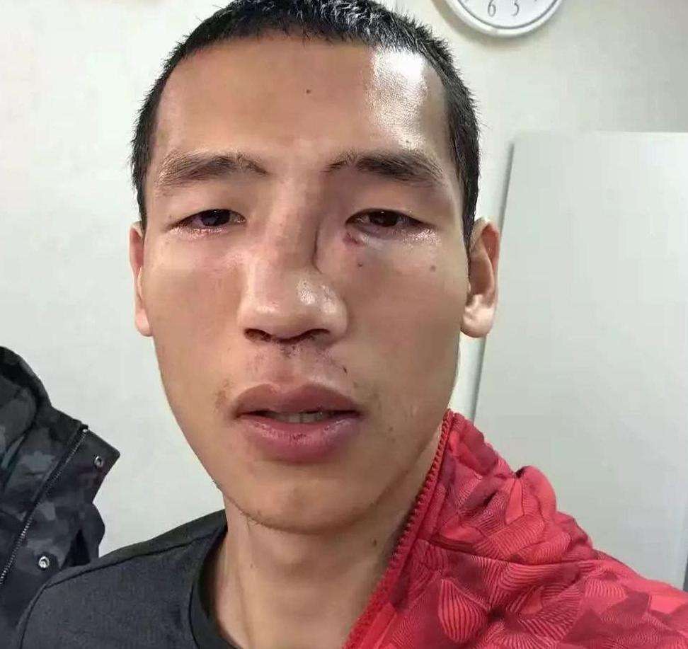 鼻子打架被打歪了治疗需要多少钱,鼻子打歪了属于什么伤
