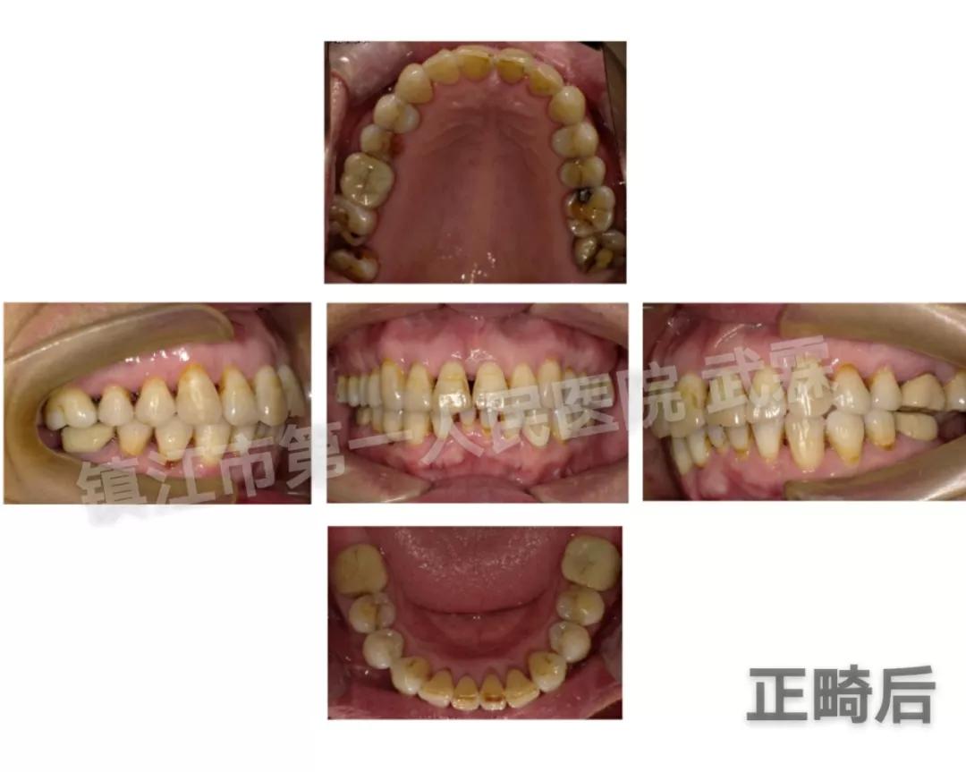 你与颜值和健康之间只差一个牙套,你与颜值巅峰只差一个发际线