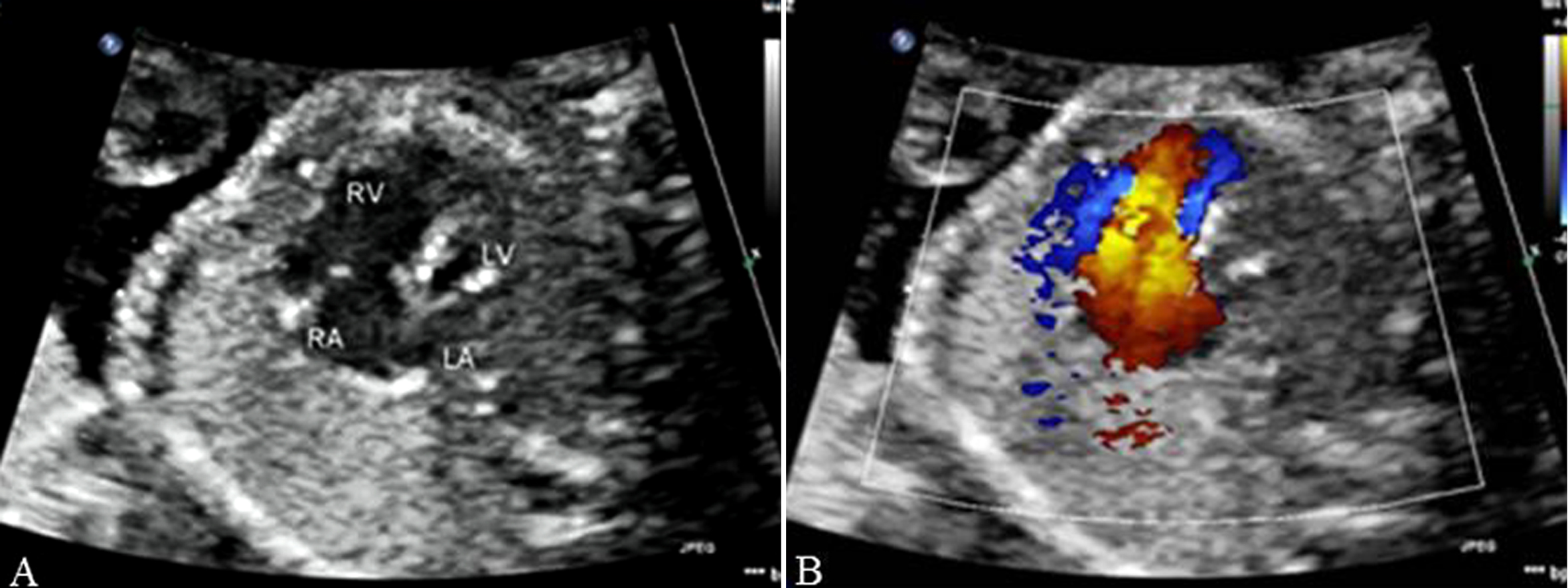 明明白白做超声26-4：胎儿心脏解剖结构异常-心室发育异常