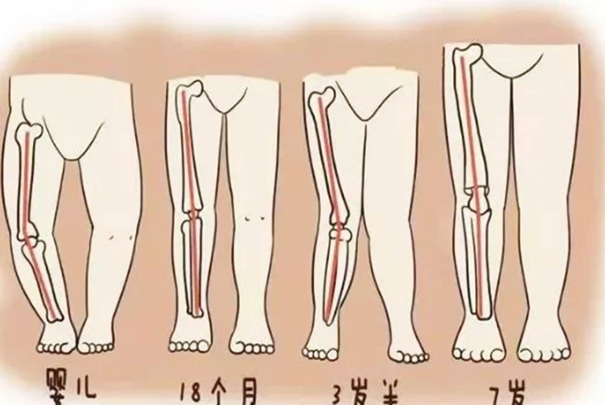 导致孩子罗圈腿的原因,小孩为什么小时候都有点罗圈腿