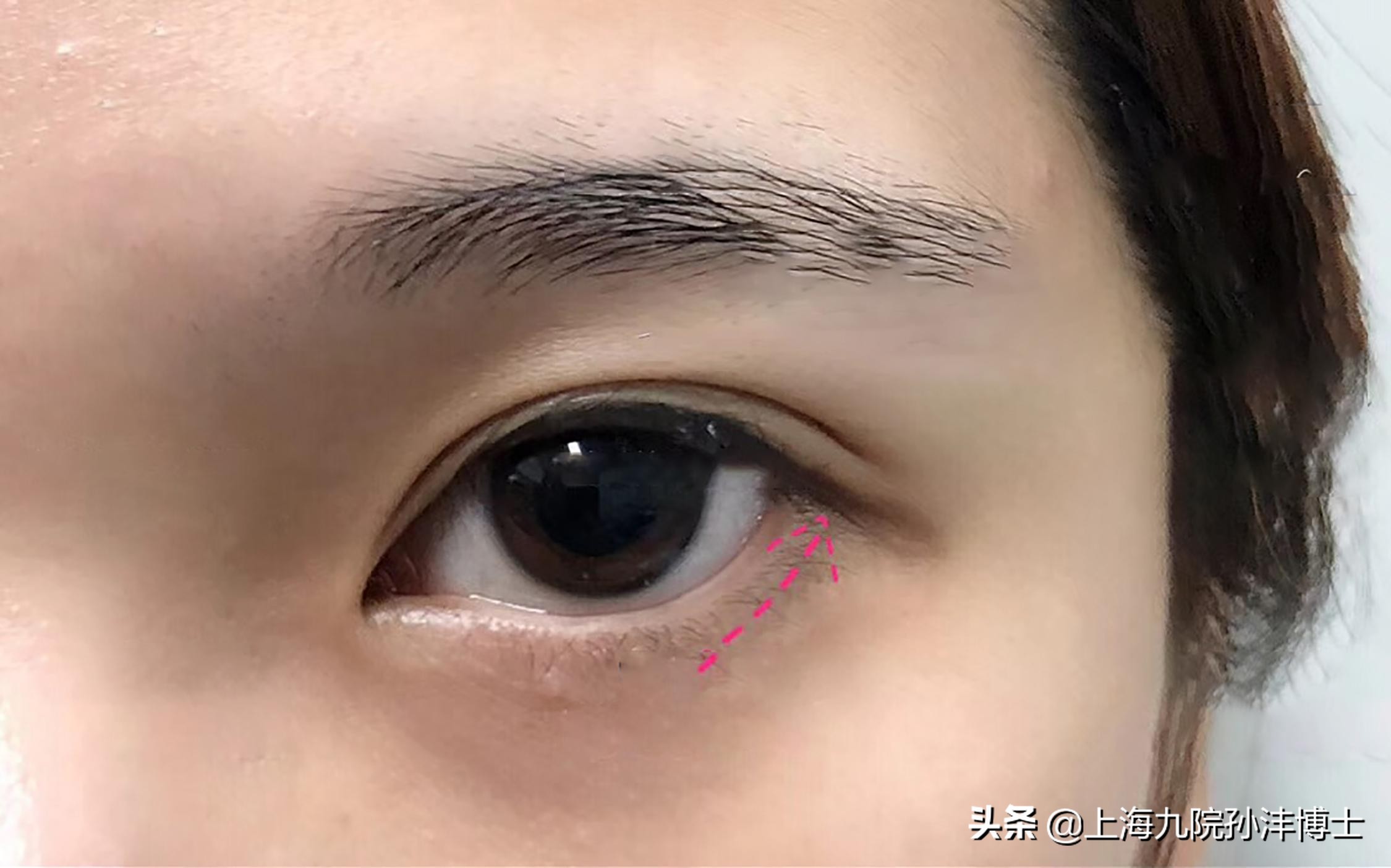 孙沣眼修复有成功案例么,眼修复能找原来医生修复吗