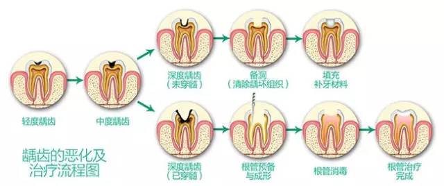 “补牙”为什么需要见牙医好几次？
