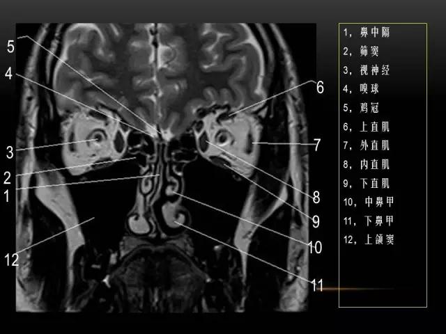 鼻腔鼻窦及颅底ct影像解剖,鼻窦解剖mri