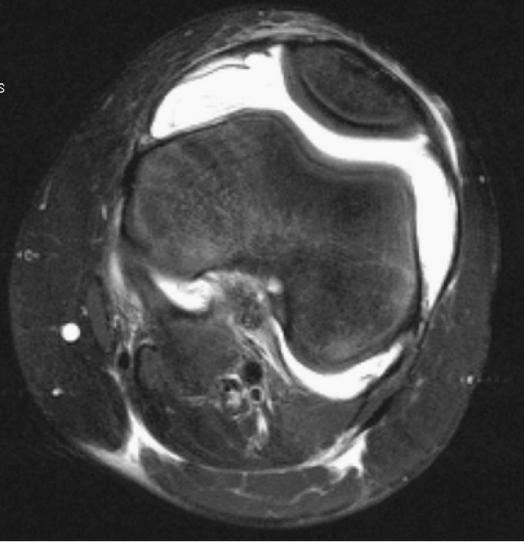 膝盖滑膜炎怎么回事,滑膜炎三大症状