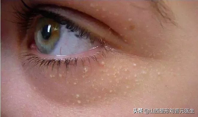 先改善细纹还是先修复抗衰,眼部显老怎么做抗衰
