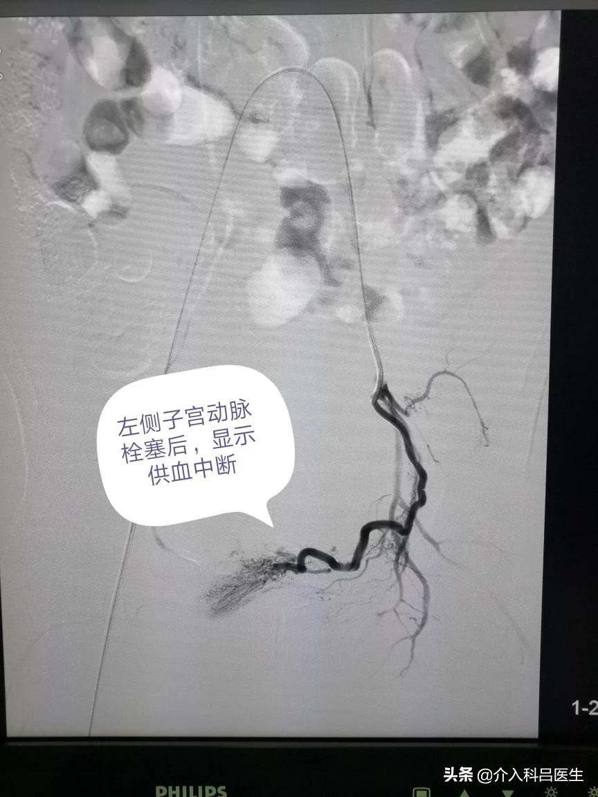 子宫腺肌症中度贫血,女性腺肌症贫血怎么调理