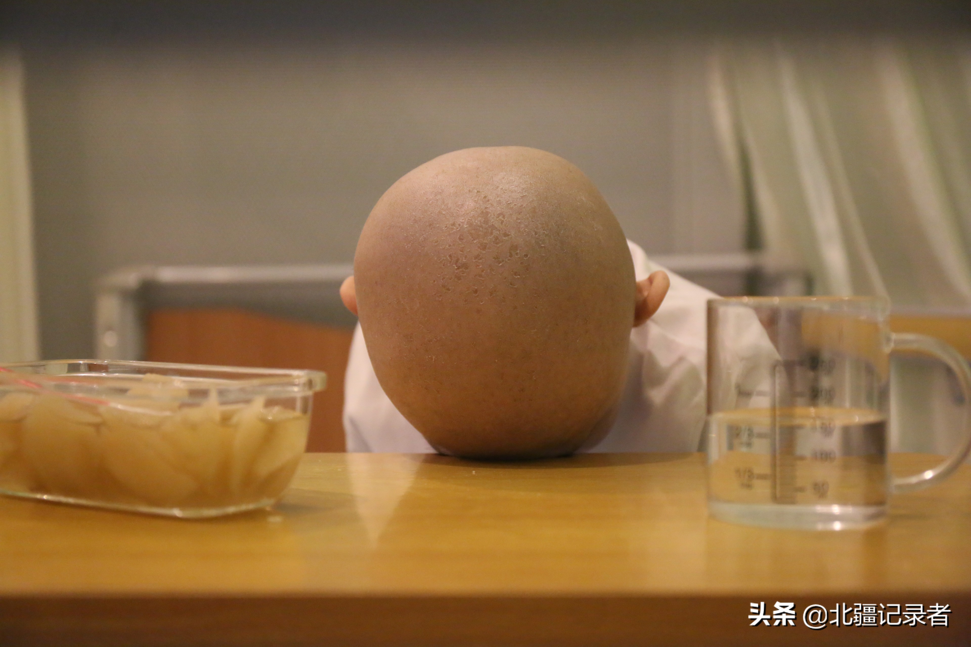 身患重病让儿子捐骨髓,老三孩子生病让大伯捐骨髓