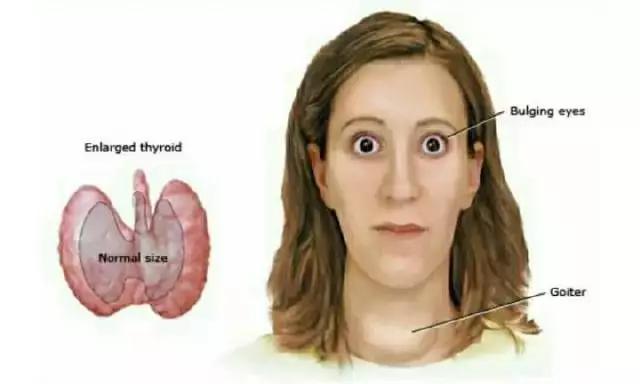 甲状腺眼病复视治愈率高吗,中医治疗甲状腺相关眼病