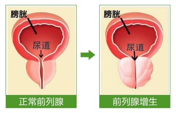 浅谈非那雄胺治疗前列腺增生