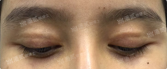 双眼皮失败眼角处有褶皱,双眼皮失败后闭眼痕迹