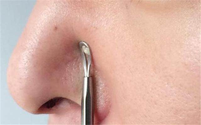 鼻子上挤出来的白色条状怎么治疗,鼻子上挤出来的黄米粒怎么办