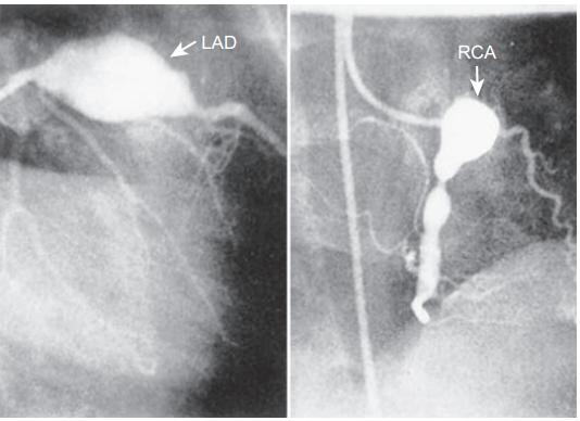 给儿童带来相对长时间发热的「川崎病」该如何治疗？