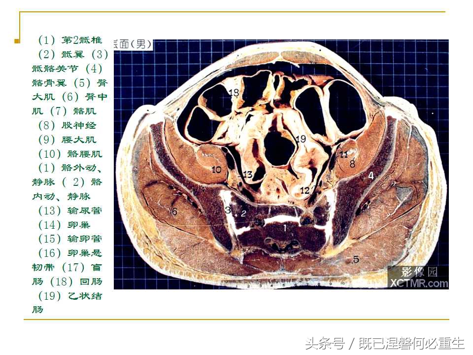男性盆腔断层解剖图谱,女性盆腔核磁断层解剖