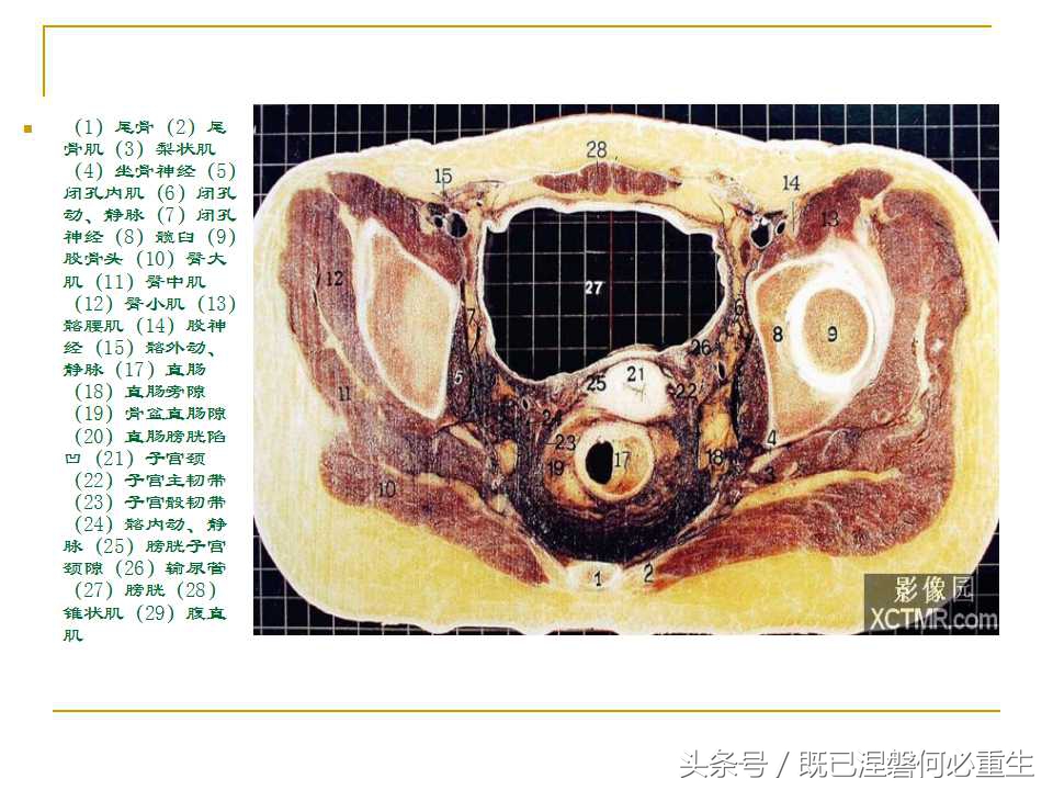 男性盆腔断层解剖图谱,女性盆腔核磁断层解剖
