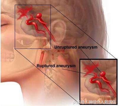 股动脉穿刺后假性动脉瘤处理,体检发现脑动脉瘤该怎么处理