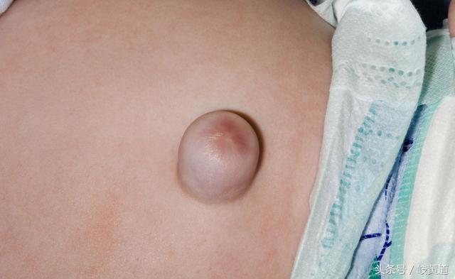 婴儿的肚脐处膨出一个圆球,宝宝肚脐眼突出一个小肉球