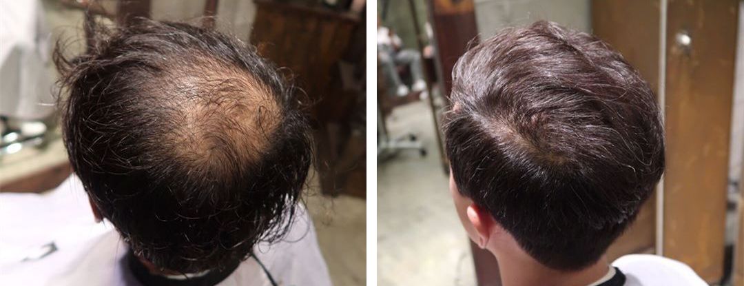 圆脸发际线高的男生适合什么发型,发际线高头发稀少发型男