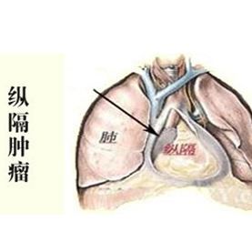 纵膈子宫是不是上不了环,纵膈子宫可以治疗吗如何进行治疗